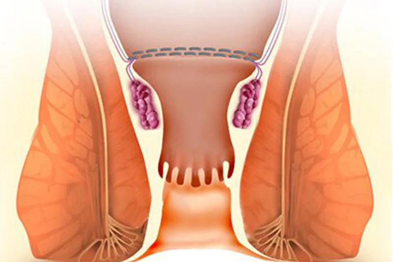 درمان بواسیر در طب بوعلی سینا - موسسه توانبخش