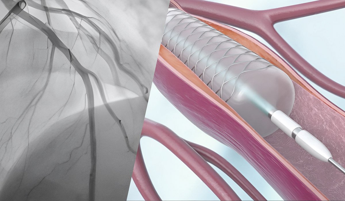 آنژیوگرافی کلید مشکلات انسداد عروقی