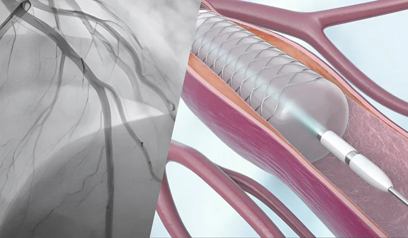 آنژیوگرافی کلید مشکلات انسداد عروقی