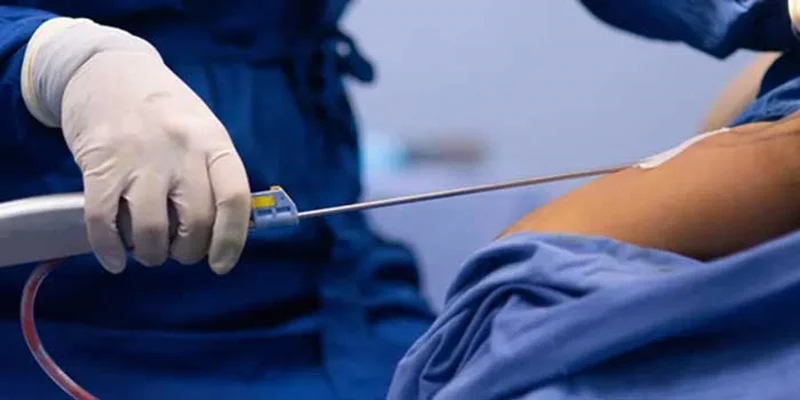 مزایا و معایب لیپوساکشن در مقایسه با روشهای دیگر