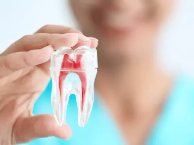 انواع درمان ریشه دندان یا عصب کشی چیست؟