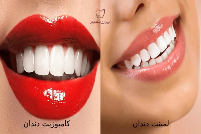 تفاوت لمینت و کامپوزیت و‌ روکش دندان چیست؟