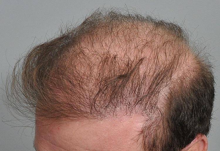 دلایل شکست کاشت مو چیست؟ راه‌هایی برای پیشگیری از نتیجه نامطلوب